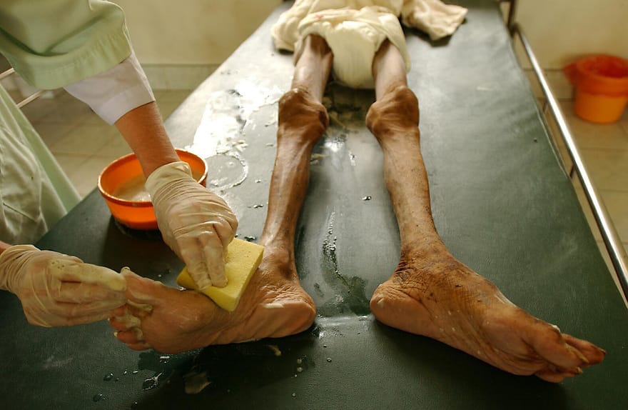 Top 10 countries with the highest HIV/AIDS rate in Europe Nurse cleaning AIDs patient dying of TB in tropical AIDs hospice near Chumphon, southern Thailand.